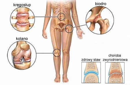 choroba zwyrodnieniowa stawów coxartroza articulației genunchiului și tratamentul acesteia